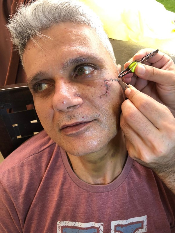 man with scar being stitched up.